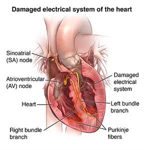 Brugada Syndrome