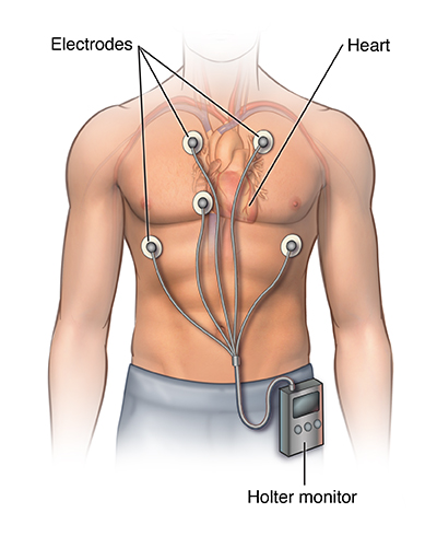 wolf parkinson syndrome ablation