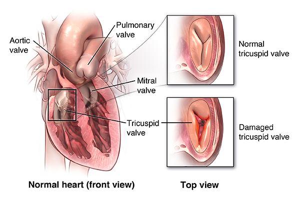 tricuspid valve replacement