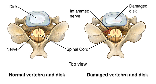 cervical disc replacement procedure