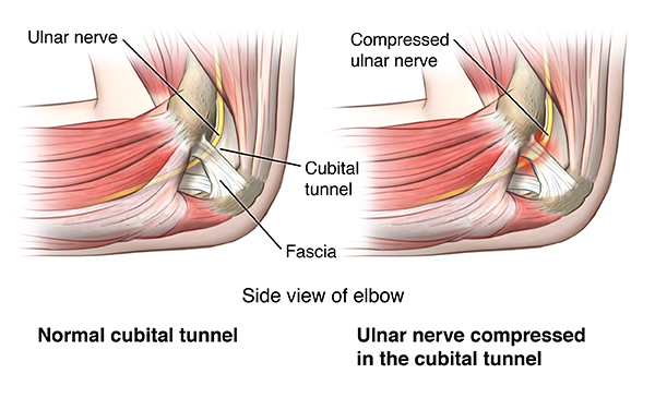 Cubital Tunnel Release - Jared Lee, MD