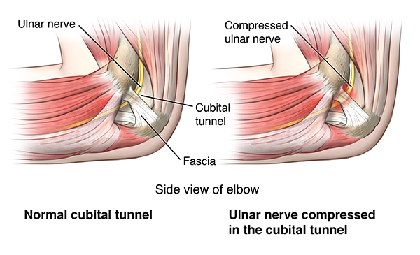 Image result for cubital tunnel syndrome