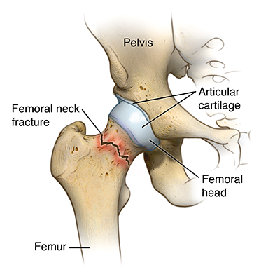 hip fracture types