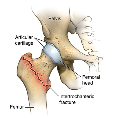 elderly broken hip recovery time