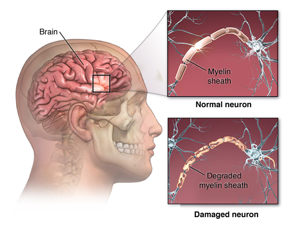 Neuromyelitis Optica | Cedars-Sinai