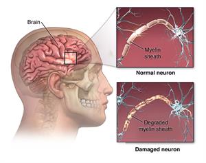 MS Attack (Relapse): Symptoms, Triggers, What To Do