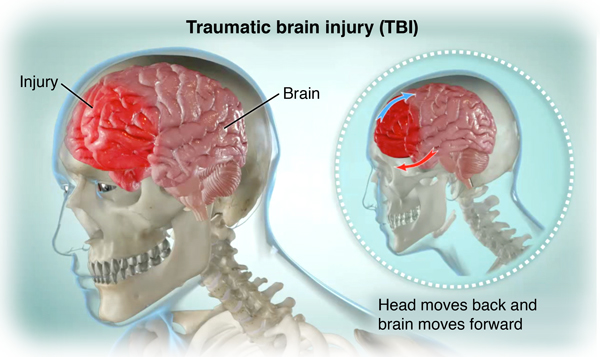 Head Injury Cedars Sinai