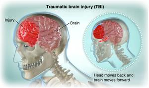 Traumatic Brain Injury Cedars Sinai