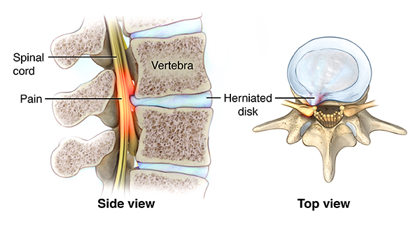 Pinched Nerve Cedars Sinai