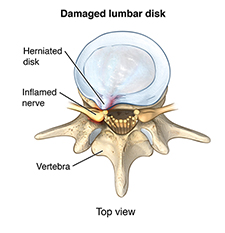 Damaged lumbar disk Damaged lumbar disk