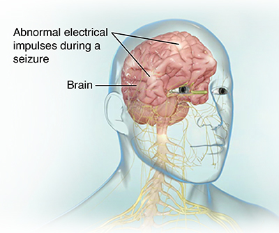 Electroencephalogram (EEG)