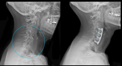 degenerative osseous changes