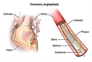 Coronary angioplasty