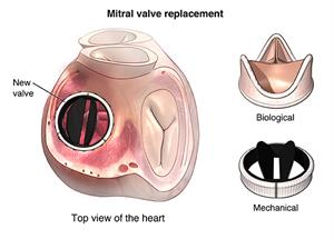 Mitral valve replacement showing new valve