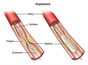 Angioplasty, showing artery with catheter, plaque, balloon and guidewire