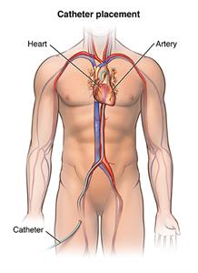 Catheter placement