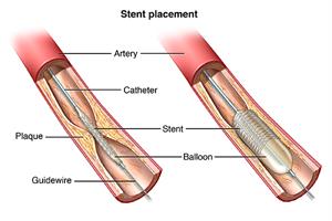 Stent placement