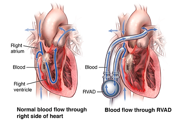 Left Ventricular Assist Devices: A Primer For the General Cardiologist