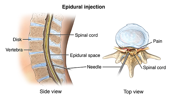 Back and Neck Pain