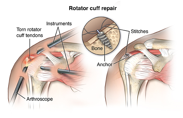 partially torn rotator cuff treatment