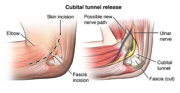 Syndrome cubital tunnel Is Cubital