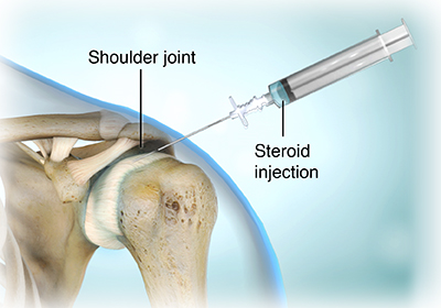 shoulder tendon pain