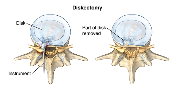 Pinched Nerve in Hip? Everything to Know About Treatment & Prevention – The  Amino Company