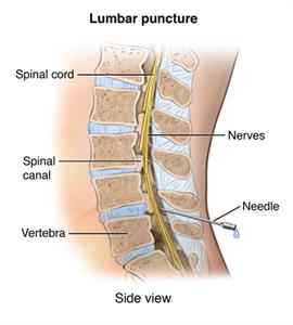 lumbar puncture meningitis