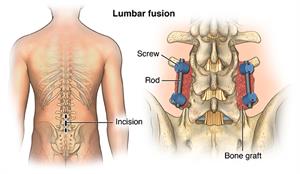 Lumbar Stenosis: Causes, Symptoms and Treatment Options for Narrowing of  the Spinal Canal and Its Impact on Lower Back Pain - Atlantic Spine  Specialists