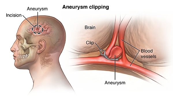 aneurysm symptoms)