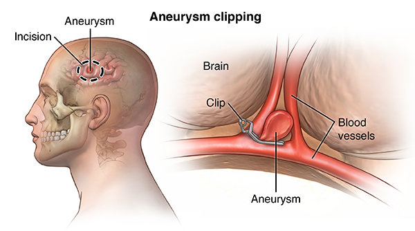 Cerebral Aneurysm Cedars Sinai