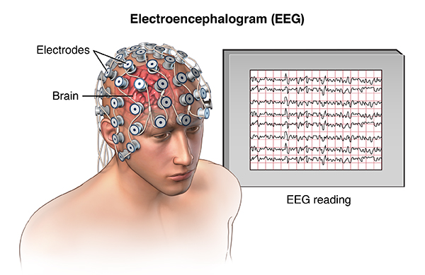 Refractory Epilepsy | Cedars-Sinai