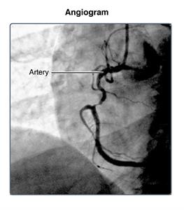 Cardiac Catheterization | Cedars-Sinai