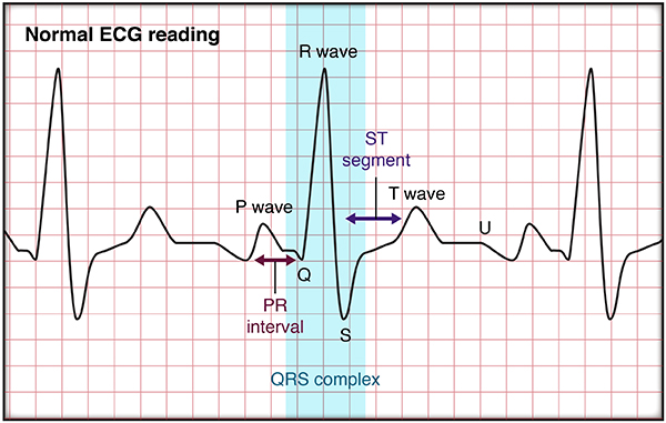 Arrhythmias Cedars Sinai