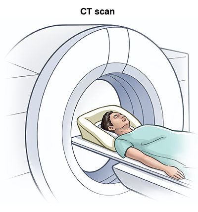 Headache Cedars Sinai