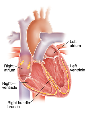 right bundle branch block