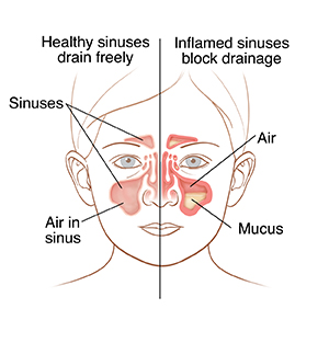 My Sinus Headache Won't Go Away: What to Do