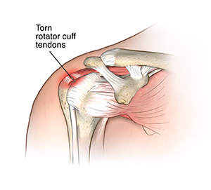 Front view of shoulder joint showing torn rotator cuff.