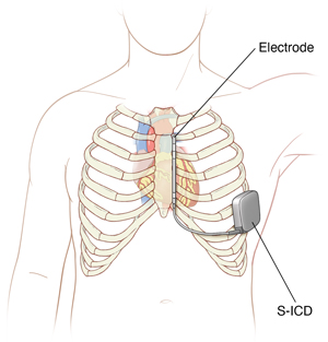 Subcutaneous Implantable Cardioverter Defibrillator (S-ICD) | Saint ...