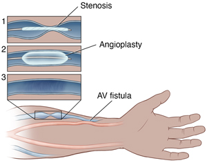 Forearm and hand with a narrowed vein connected to an artery used for dialysis. An inset shows the steps of an angioplasty to fix the vein.