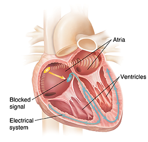 Atrioventricular Block, Heart Block