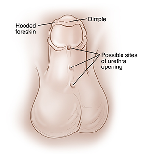 When Your Child Needs Surgery for Hypospadias Saint Luke s