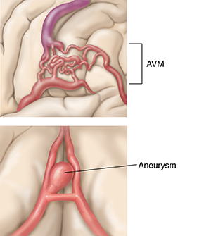 When Your Child Has Intracranial Hemorrhage