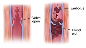 What Are Vaginal Blood Clots 