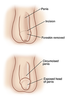 Foreskin care in children