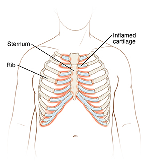 Costochondritis  Saint Luke's Health System