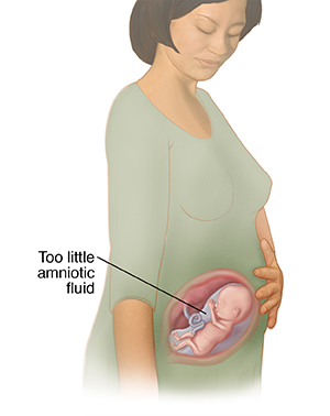 Oligohydramnios  Saint Luke's Health System