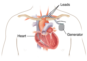 Outline of man's chest showing showing biventricular pacemaker ICD  in chest with three leads going into heart chambers.