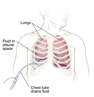 Discharge Instructions for Thoracentesis | Saint Luke's Health System