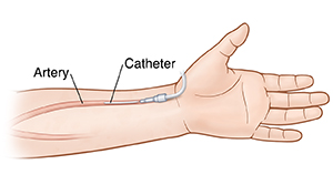 HAND-AID Arterial Wrist Support